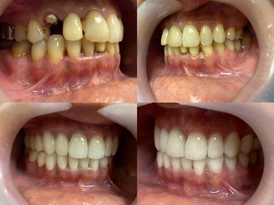 couronne-zircone-implant-dentaire-hongrie